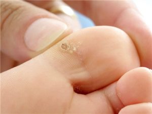 Wart removal in Singapore - Wart on sole of the foot