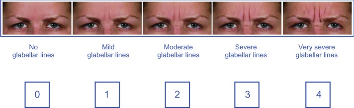 Merz 5-point scale for glabellar frown lines - Singapore Aesthetic Clinic